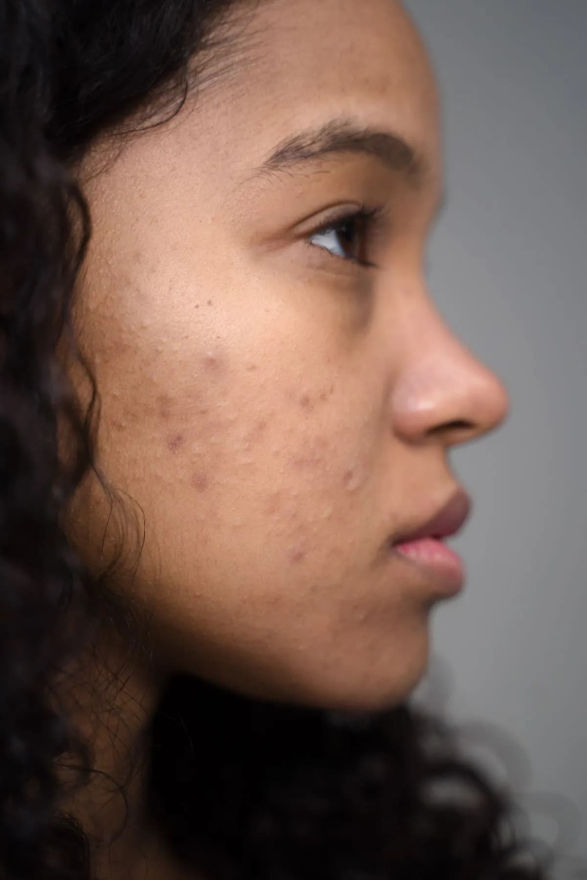 A young woman in profile, breakout across her cheek