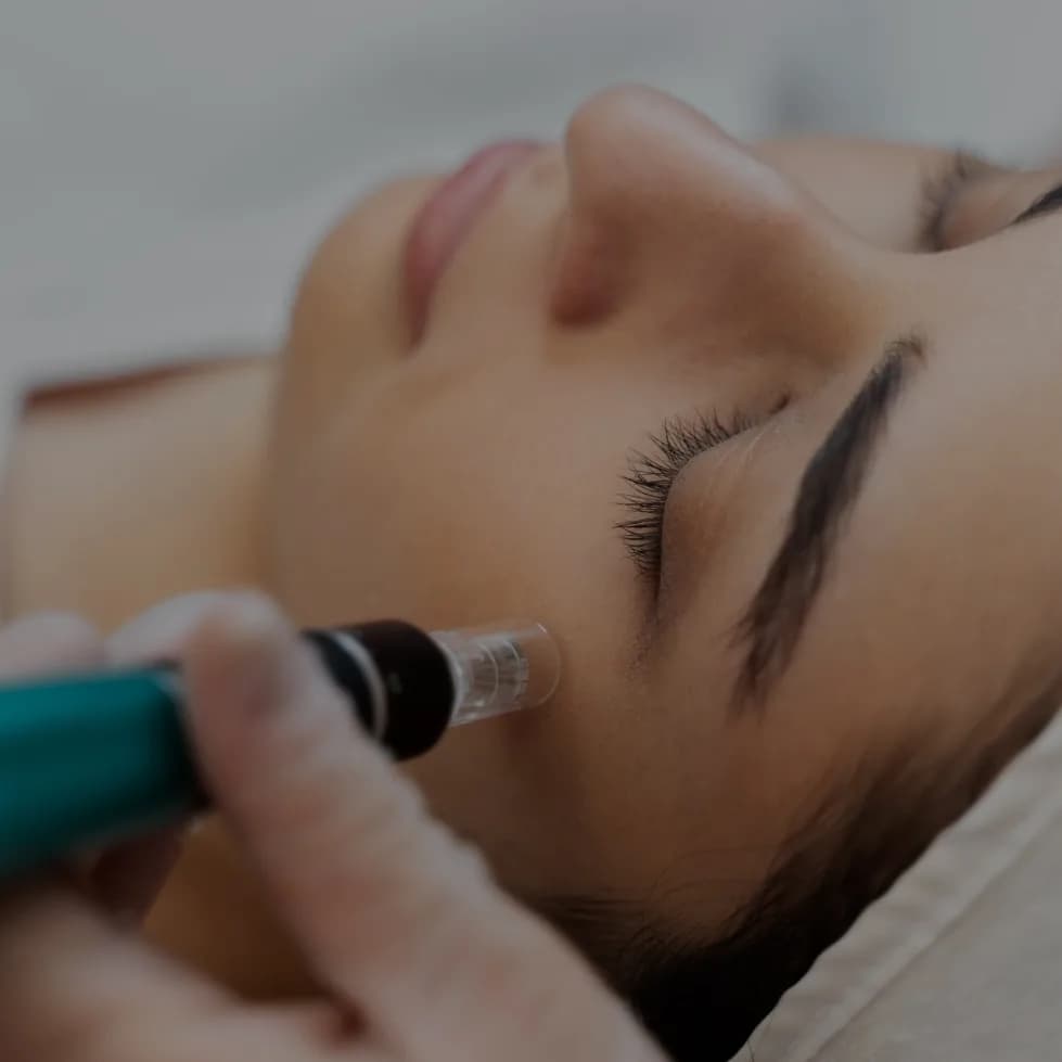 A microneedling pen moving across the brow of a client with closed eyes